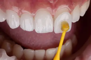 Dental Veneers
